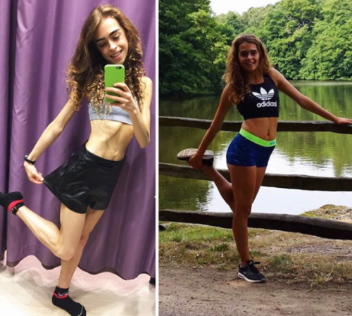 Las Sorprendentes Imágenes De Personas Que Le Ganaron A La Anorexia Soy502