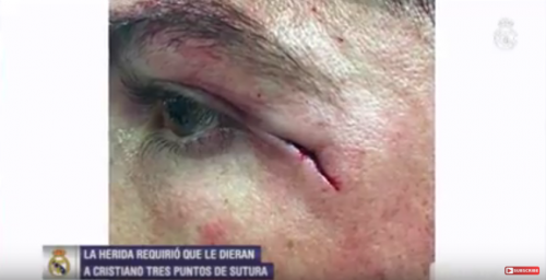 Así quedó la herida de Ronaldo luego del partido. (Foto: captura de video) 