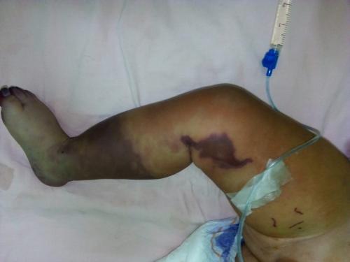 Así estaba la pierna de Walter antes de ser trasladado de emergencia al Hospital San Juan de Dios. (Foto: Cortesía de la familia)