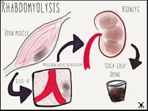 Rabdomiólisis. (Foto:Medpics)