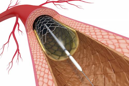 Cirugía endovascular. (Foto: Southwestern Medical Center)