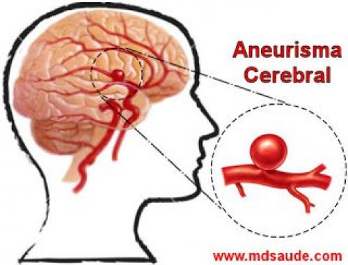 Aneurisma. (Foto: Dr. Adrian Santana Ramirez)