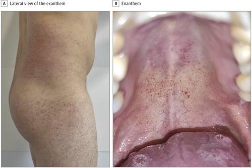 Así aparece el sarpullido en algunos pacientes con Covid-19: esparcido por el cuerpo y en la boca (Foto: Infobae)