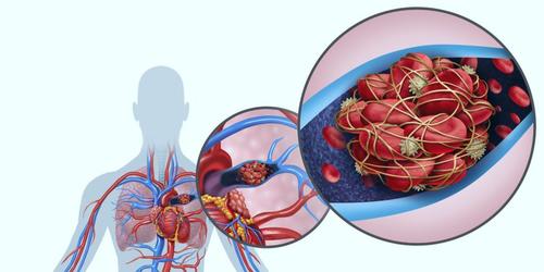 La embolia pulmonar es una afección en la que una o más arterias de los pulmones queda obstruida por un coágulo sanguíneo. (Foto: Cuídate plus)