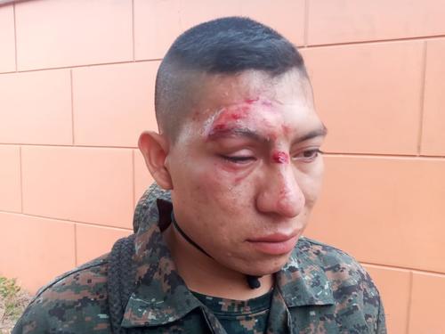El cabo Rudy Leonel Vásquez es uno de los soldados lesionados. (Foto: Ministerio de la Defensa) 