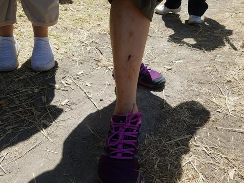 Una de las vecinas de Nimajuyú muestra las heridas que le causaron los supuestos invasores. (Foto: Jessica Gramajo/Soy502)