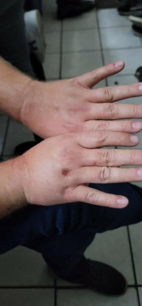 Una de las manos de Daniel se encuentra inflamada por un golpe recibido. (Foto: Cortesía)