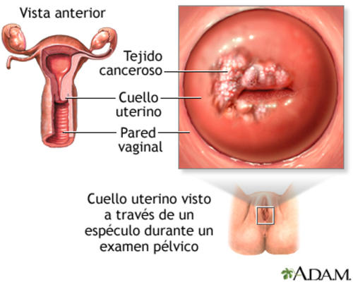 El VPH está asociado al cáncer cervicouterino. (Foto: MedlinePlus)
