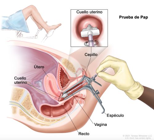 La prueba de Papanicolau sirve para detectar de forma temprana el cáncer cervicouterino. (Foto: NHI)