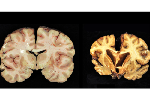 Cerebro sin CTE (Izquierda), Cerebro con CTE (derecha)