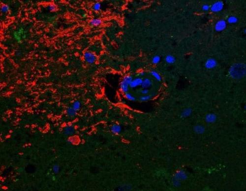 Cerebro de una persona con Alzheimer, el rojo representa a las proteínas sanas. (Foto: Oregon Health and Science University)