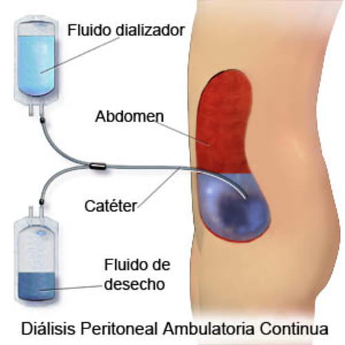 En el proceso el peritoneo se utiliza como filtro para la diálisis. 