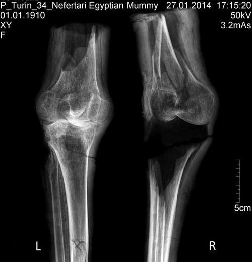 Radiografía de las piernas momificadas, las cuales muestran rastros de artritis. (Foto: abc.es)