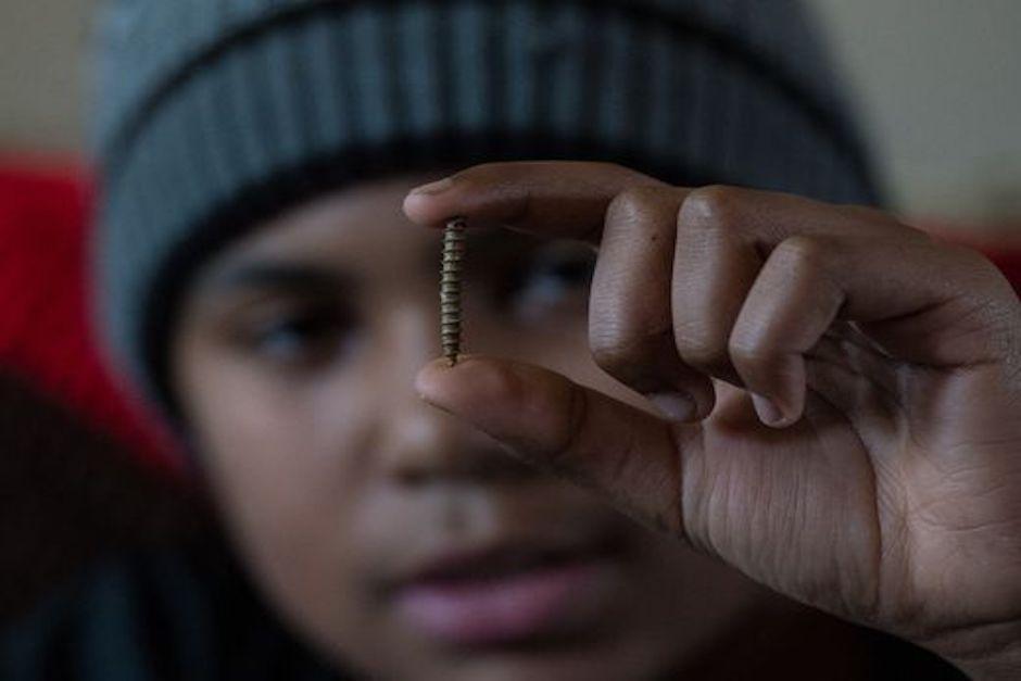 El adolescente recibió como regalo el tornillo que estuvo a un milímetro de causarle la muerte. (Foto: Usa Today)