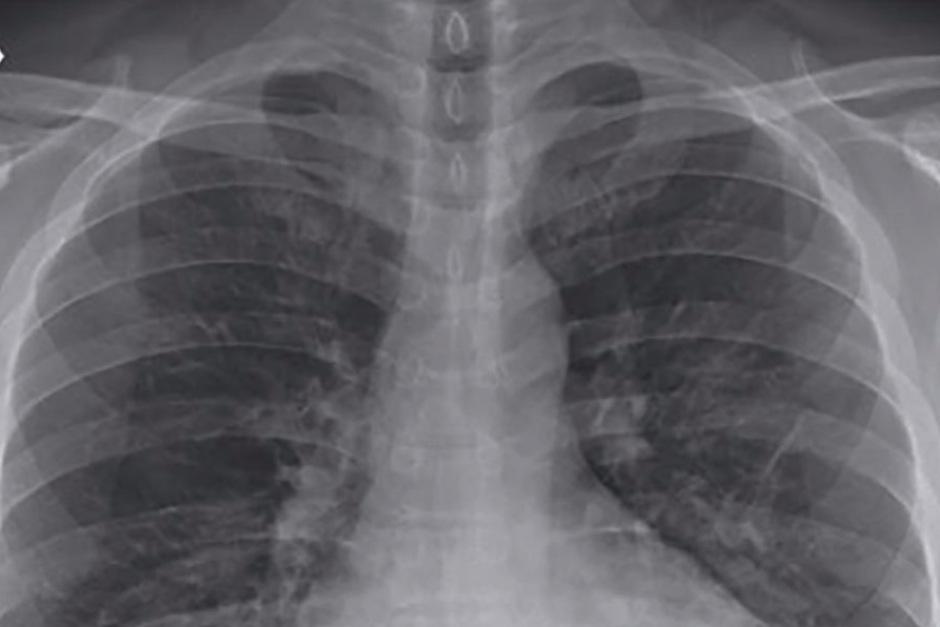 El Covid-19 podría seguir en los pulmones de pacientes. (Foto: CNN)