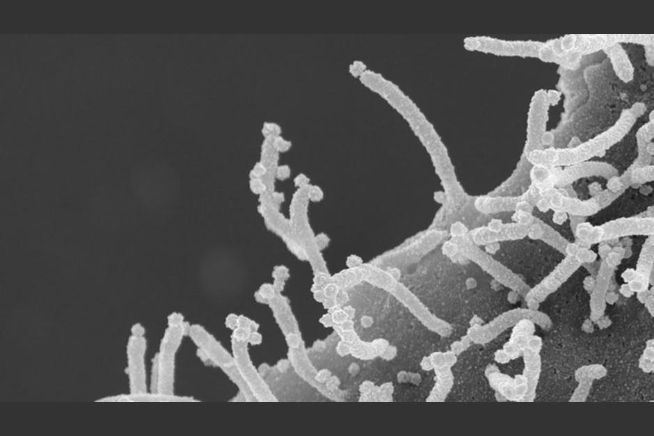 Imágenes muestran el siniestro ataque del coronavirus a las células humanas. (Foto: UC San Francisco)