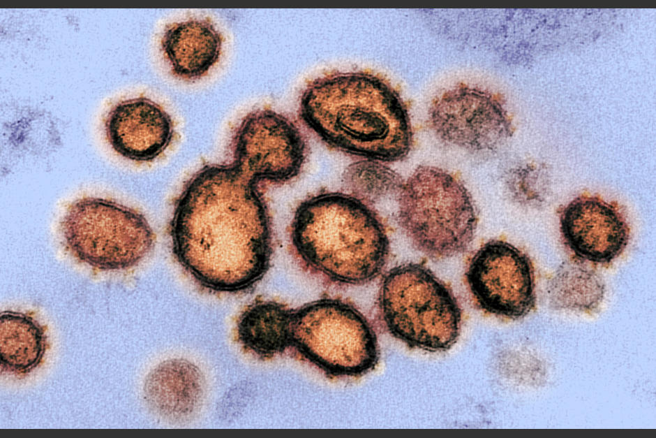 Las imágenes muestran cómo afecta el virus las células hasta causar estragos en la salud de los pacientes. (Foto: Instituto Nacional de Alergias y Enfermedades Infecciosas)