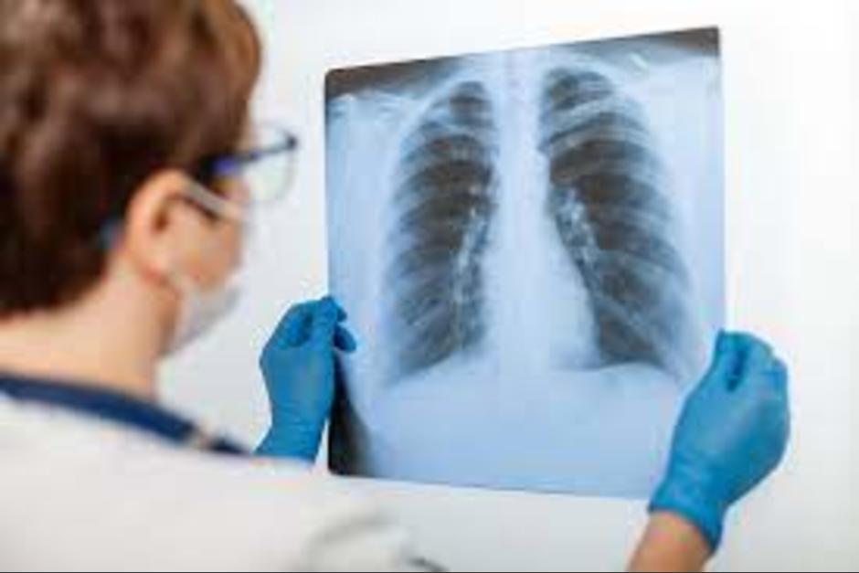 Los pulmones de los fallecidos por Covid-19 fueron más afectados, según estudio. (Foto: 65YMás)