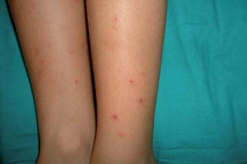 El chikungunya causa fiebre alta y repentina, erupciones en la piel, dolor de cabeza, dolores musculares y articulares. (Foto: elnacional.com)