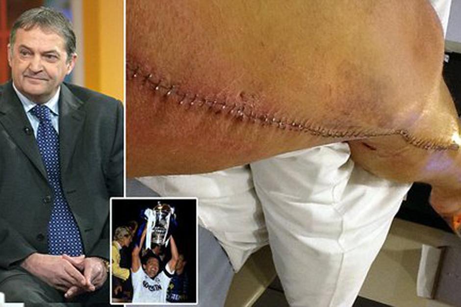 Gary Mabbutt necesitó de un corte de 30 pulgadas en su pierna y una sutura de 112 grapas para no perder su extremidad. (Foto: dailymail.co.uk)