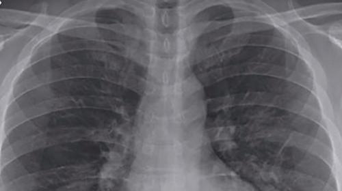 Covid-19 podría seguir en pulmones de recuperados, dice estudio