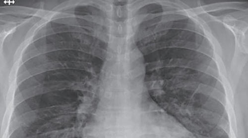 Pulmones de pacientes con Covid se dañan más que los de fumadores